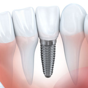 Azonnali fogászati implantáció